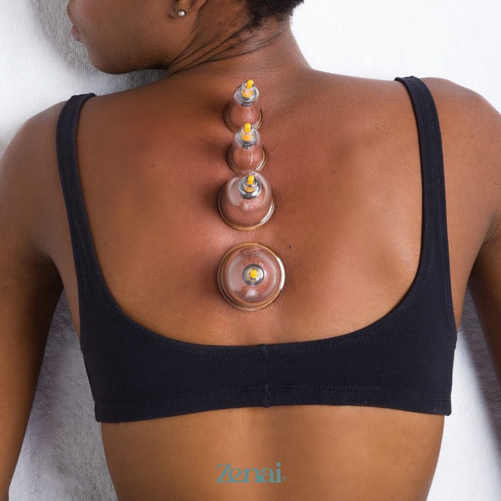 Ventosaterapia para que serve